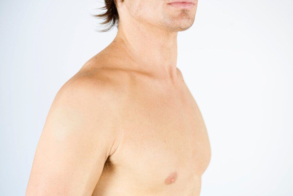 gynecomastia male chest profile shoulder view