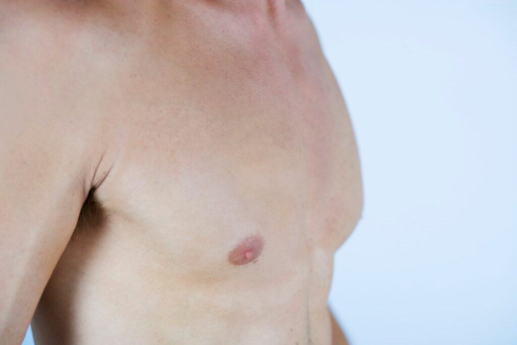 gynecomastia surgery day chest side