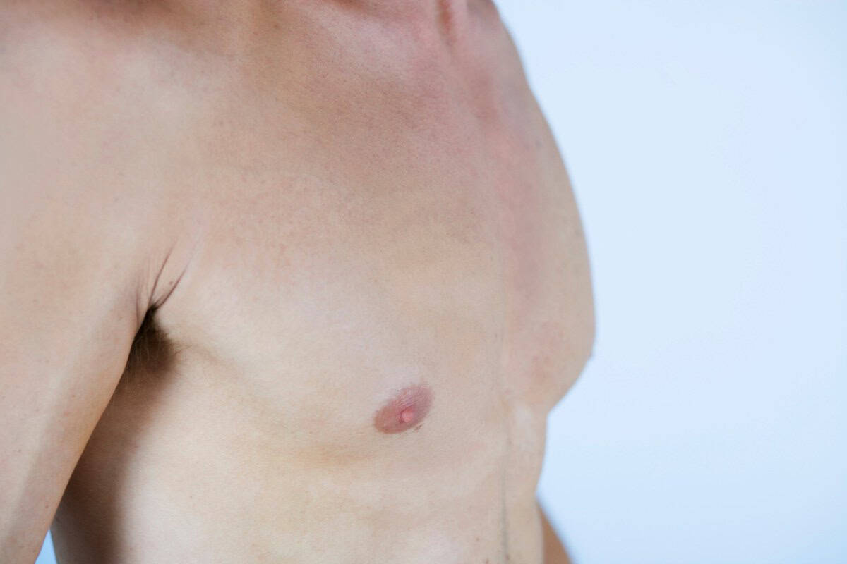 gynecomastia surgery day chest side